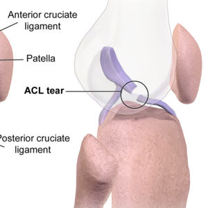 Anterior and Posterior cruciate ligament injuries